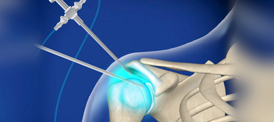 Shoulder arthroscopy in Chennai